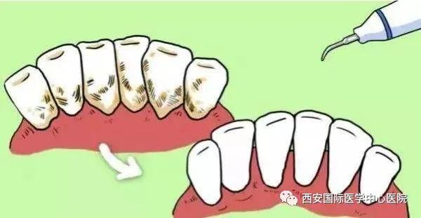 【科普】牙齒上的黃斑好難看，三招告訴你如何預(yù)防氟斑牙