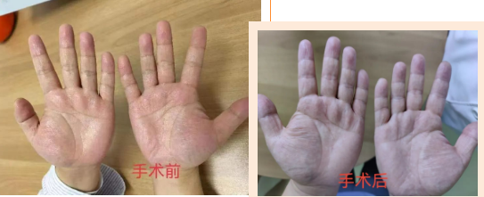 胸外科專(zhuān)家微創(chuàng)手術(shù)根治“手汗” 助患者重返社交圈