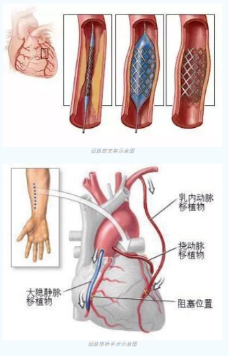 魚(yú)與熊掌不可兼得？冠脈雜交手術(shù)一站式解決問(wèn)題