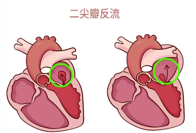 體檢報告里的心臟瓣膜返流，你讀懂了嗎？